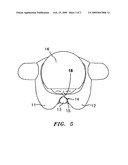 Suspension-styled brassiere primarily for minimization of intra-breast wrinkling diagram and image