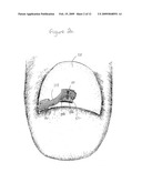 DEVICE AND METHOD FOR TREATING INGROWN NAILS diagram and image