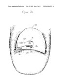 DEVICE AND METHOD FOR TREATING INGROWN NAILS diagram and image