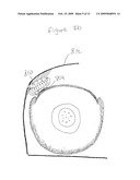 DEVICE AND METHOD FOR TREATING INGROWN NAILS diagram and image