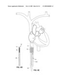 INTRAVASCULAR DELIVERY SYSTEM FOR THERAPEUTIC AGENTS diagram and image