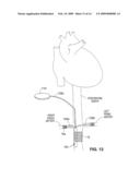 INTRAVASCULAR DELIVERY SYSTEM FOR THERAPEUTIC AGENTS diagram and image