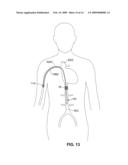 INTRAVASCULAR DELIVERY SYSTEM FOR THERAPEUTIC AGENTS diagram and image