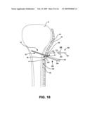 Surgical lag tool devices and methods for use with surgical bone screw/plate systems diagram and image