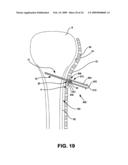 Surgical lag tool devices and methods for use with surgical bone screw/plate systems diagram and image