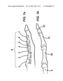 DEVICE AND METHOD FOR ASSISTING IN FLEXOR TENDON REPAIR AND REHABILITATION diagram and image