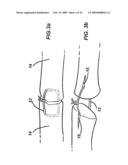 DEVICE AND METHOD FOR ASSISTING IN FLEXOR TENDON REPAIR AND REHABILITATION diagram and image