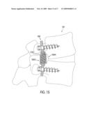 Dynamic Stabilization Device for Spine diagram and image