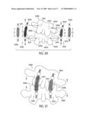 Dynamic Stabilization Device for Spine diagram and image