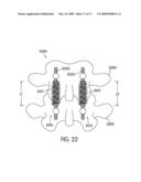 Dynamic Stabilization Device for Spine diagram and image