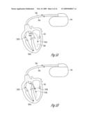 CLOSED LOOP IMPEDANCE-BASED CARDIAC RESYNCHRONIZATION THERAPY SYSTEMS, DEVICES, AND METHODS diagram and image