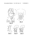 Appendicular and rectal stimulator device for digestive and eating disorders diagram and image