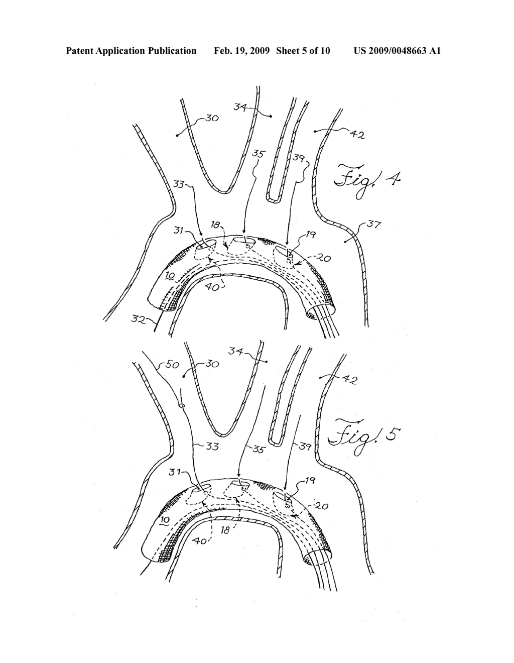 BRANCHED STENT GRAFT SYSTEM - diagram, schematic, and image 06