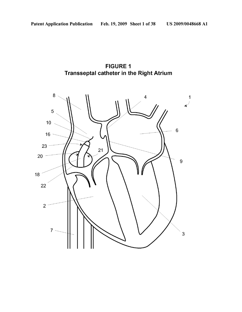 System and Method for Implanting a Heart Implant - diagram, schematic, and image 02