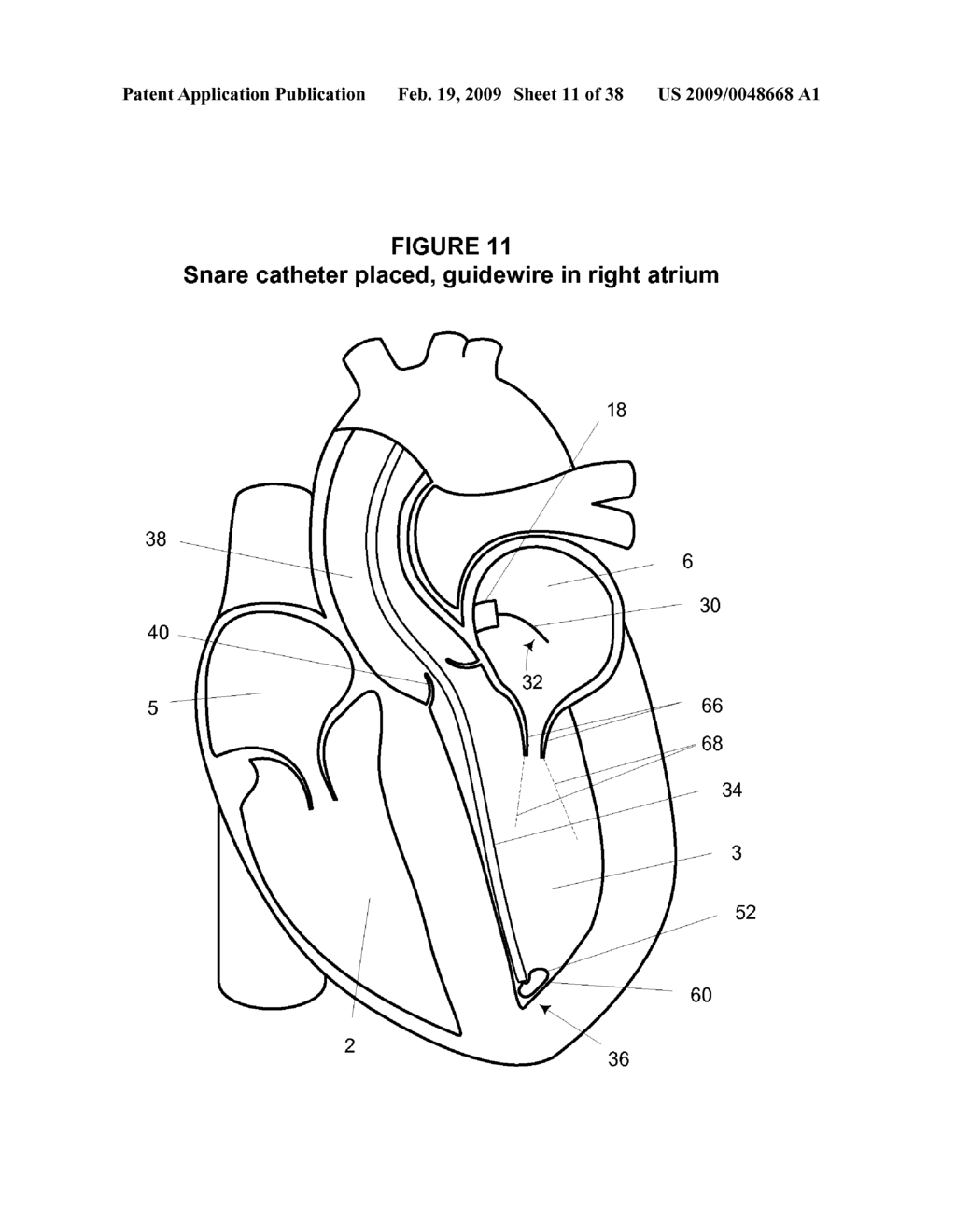 System and Method for Implanting a Heart Implant - diagram, schematic, and image 12