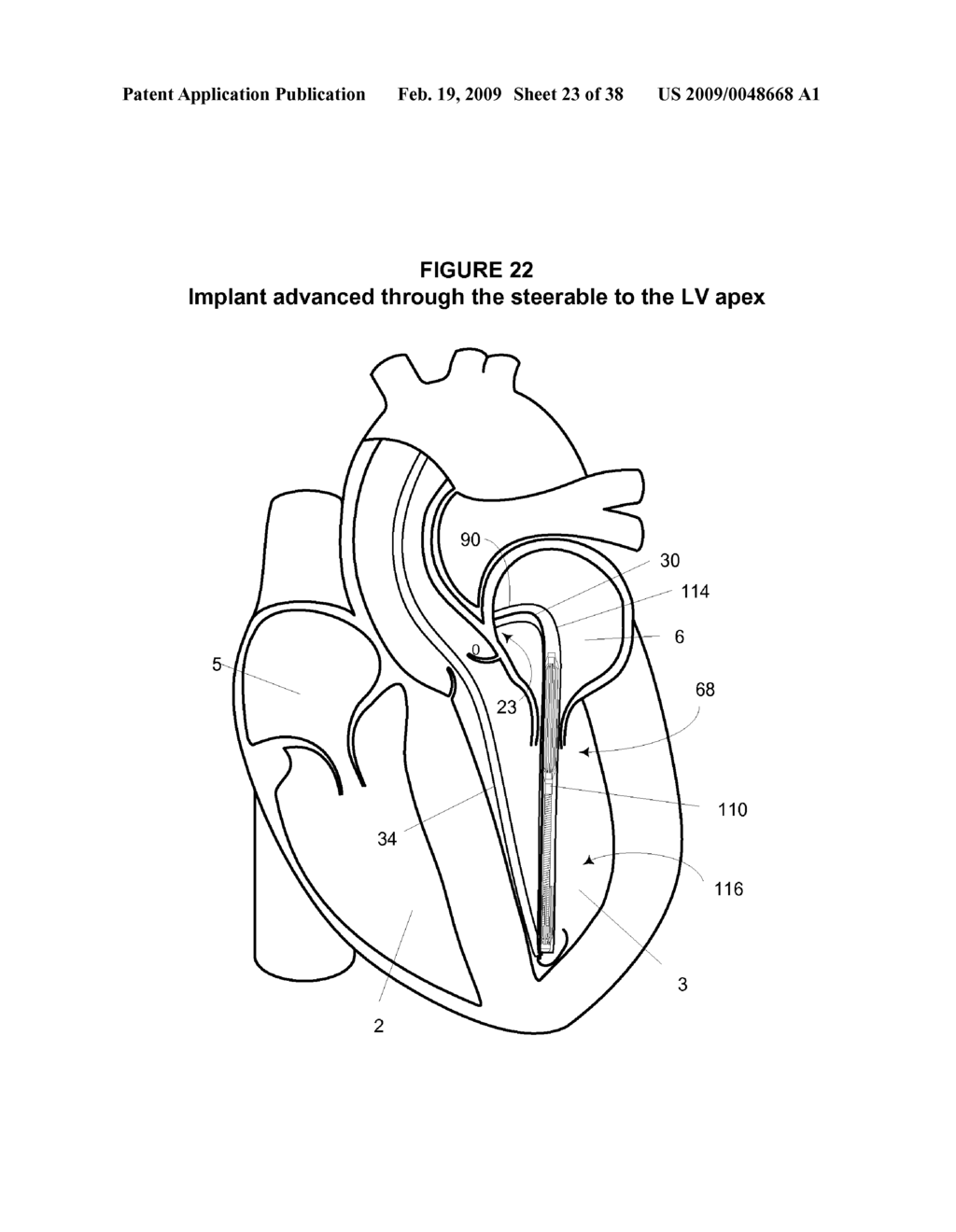 System and Method for Implanting a Heart Implant - diagram, schematic, and image 24