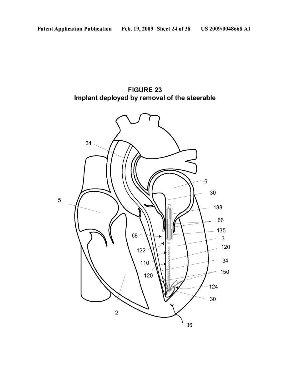 System and Method for Implanting a Heart Implant - diagram, schematic, and image 25