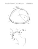 IMPLANT diagram and image