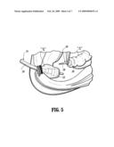 Structure Containing Wound Treatment Material diagram and image