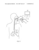 Manipulatable guide system and methods for natural orifice translumenal endoscopic surgery diagram and image