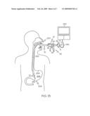 Manipulatable guide system and methods for natural orifice translumenal endoscopic surgery diagram and image