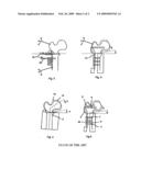 Implant Location Positioning System diagram and image