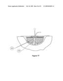 APPARATUS FOR ASPIRATING, IRRIGATING AND/OR CLEANSING OF WOUNDS diagram and image