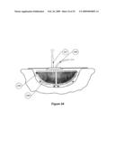 APPARATUS FOR ASPIRATING, IRRIGATING AND/OR CLEANSING OF WOUNDS diagram and image