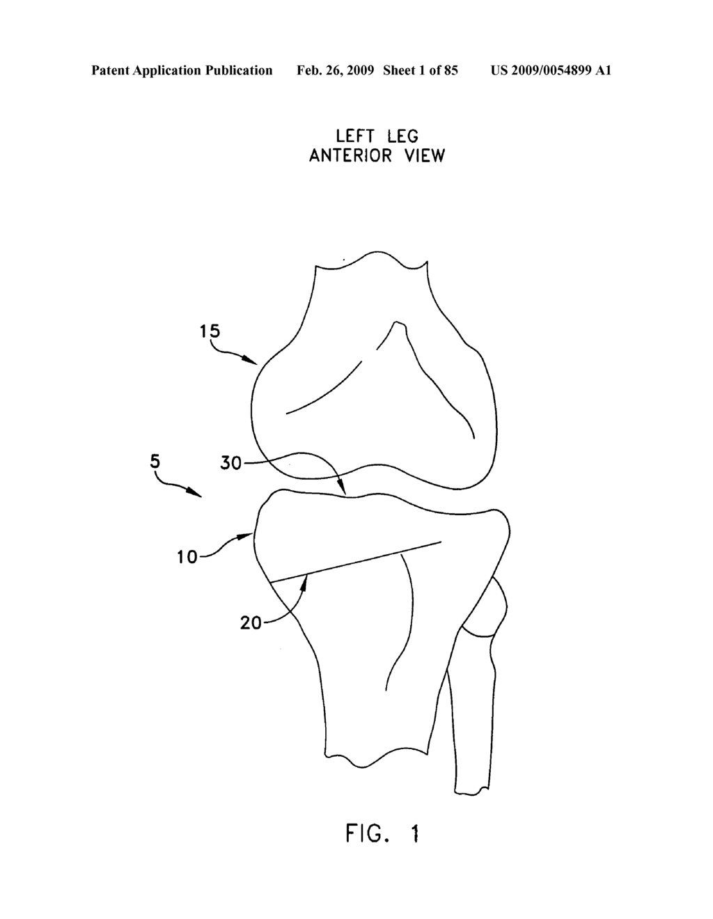 Method and apparatus for performing an open wedge, high tibial osteotomy - diagram, schematic, and image 02