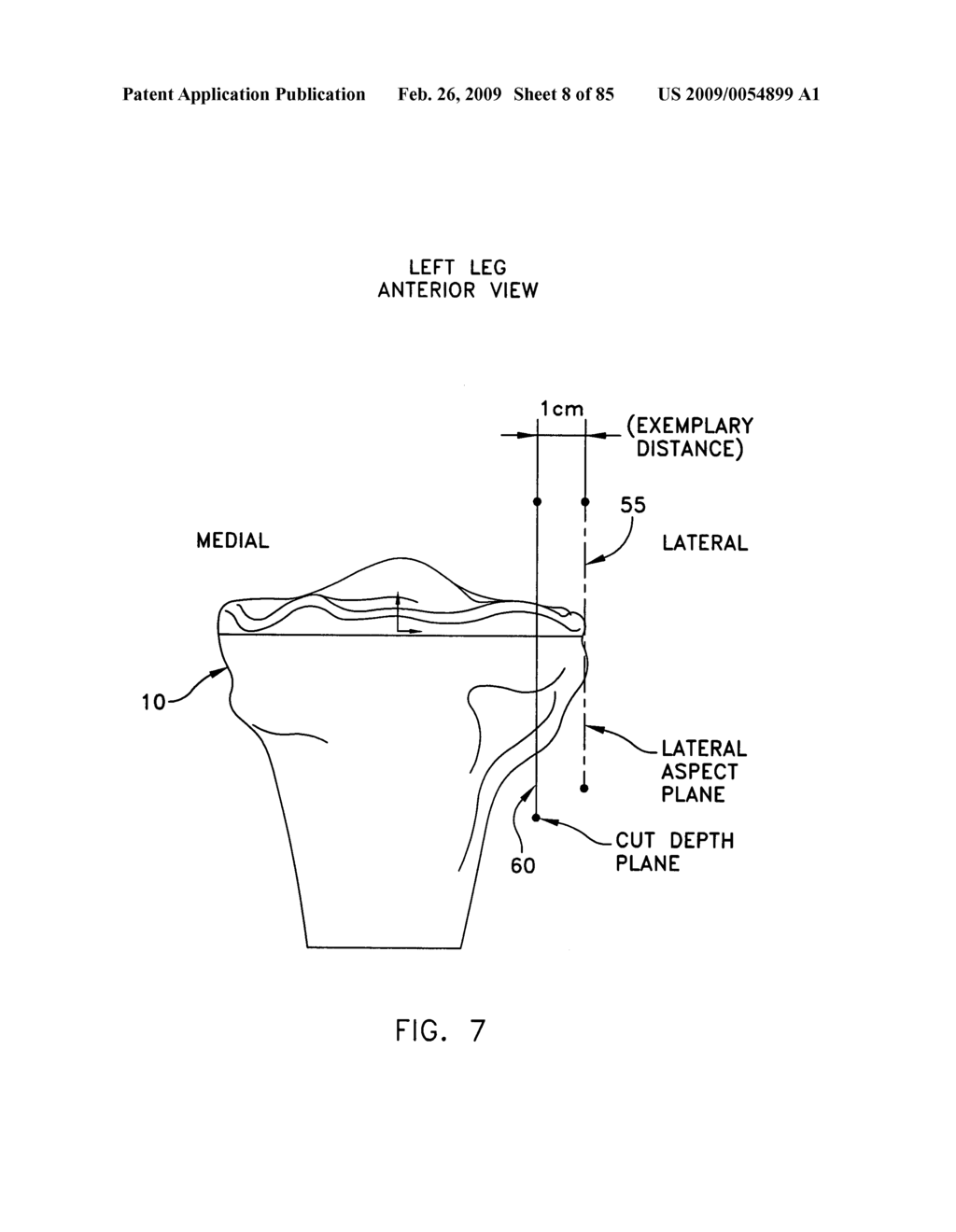 Method and apparatus for performing an open wedge, high tibial osteotomy - diagram, schematic, and image 09