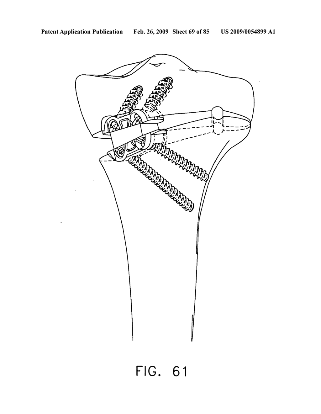 Method and apparatus for performing an open wedge, high tibial osteotomy - diagram, schematic, and image 70