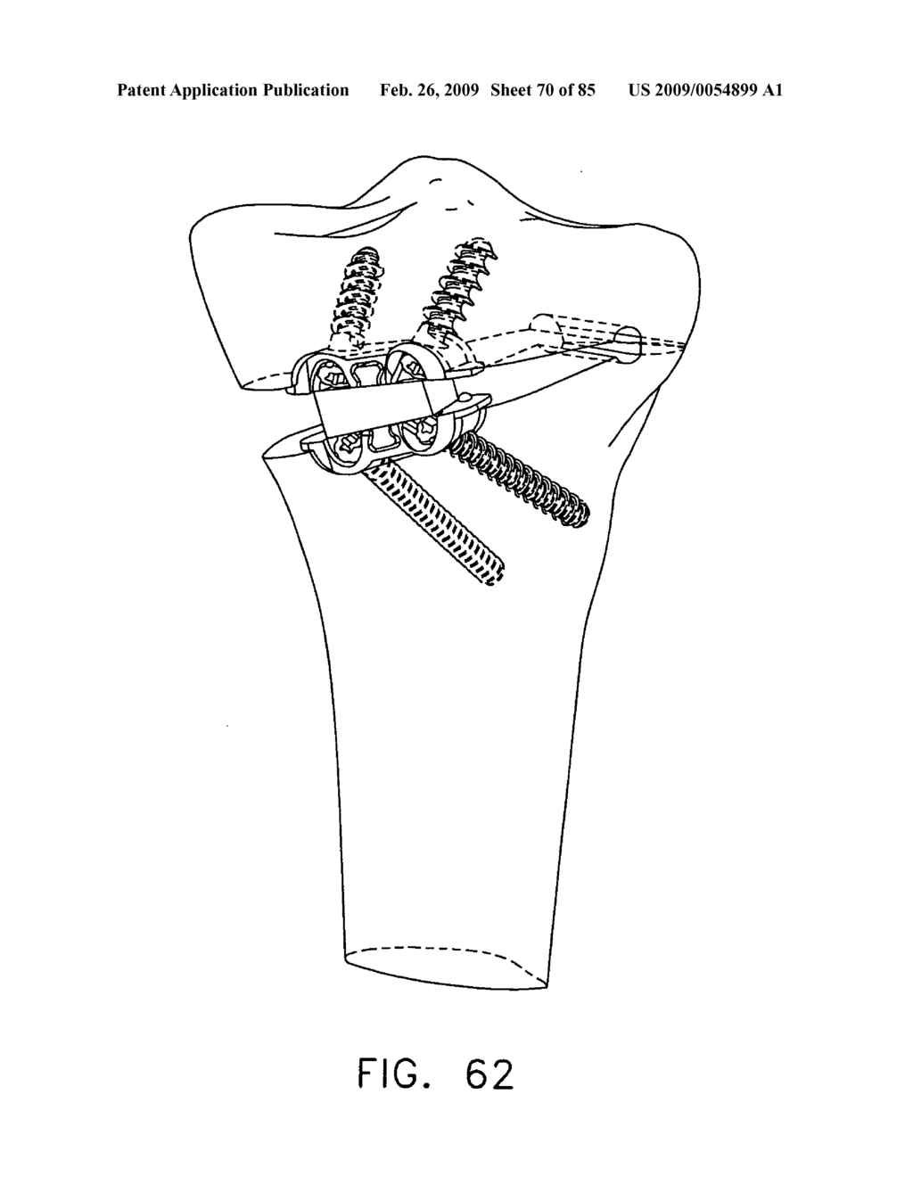 Method and apparatus for performing an open wedge, high tibial osteotomy - diagram, schematic, and image 71