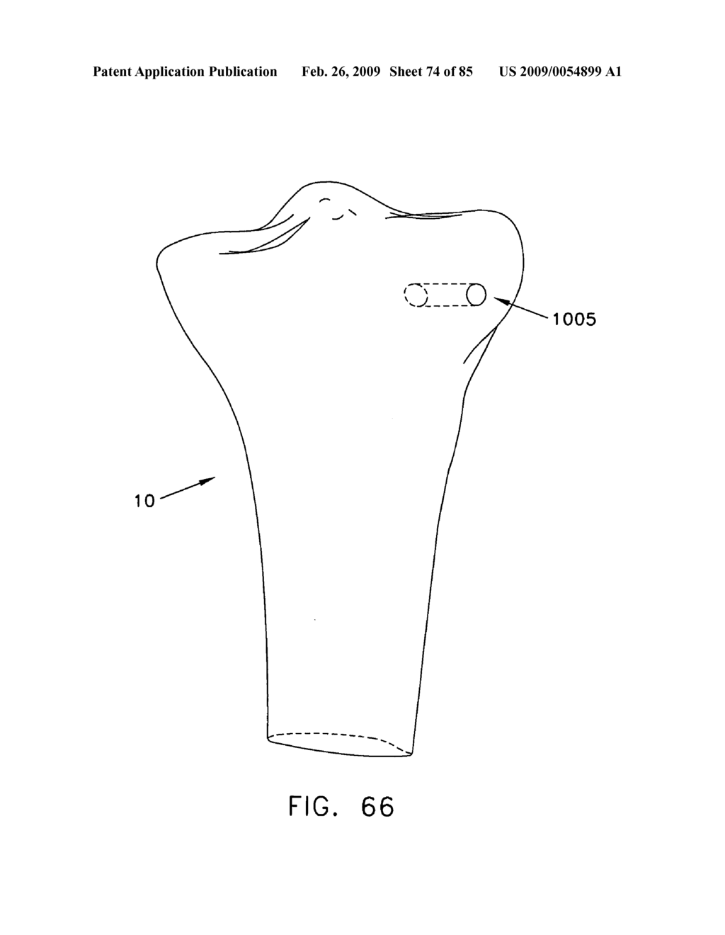 Method and apparatus for performing an open wedge, high tibial osteotomy - diagram, schematic, and image 75