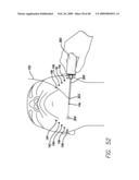 SURGICAL THREADING DEVICE AND METHOD FOR USING SAME diagram and image