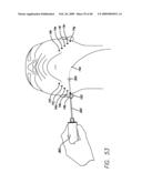 SURGICAL THREADING DEVICE AND METHOD FOR USING SAME diagram and image