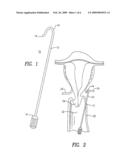 OBSTRUCTION OF UTERINE ARTERIES TO TREAT UTERINE FIBROIDS USING MECHANICAL INSTRUMENTS TO TWIST THE VESSELS diagram and image