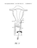OBSTRUCTION OF UTERINE ARTERIES TO TREAT UTERINE FIBROIDS USING MECHANICAL INSTRUMENTS TO TWIST THE VESSELS diagram and image