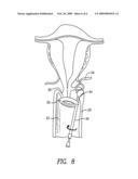 OBSTRUCTION OF UTERINE ARTERIES TO TREAT UTERINE FIBROIDS USING MECHANICAL INSTRUMENTS TO TWIST THE VESSELS diagram and image