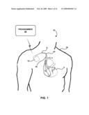 ELECTRODE CONFIGURATIONS FOR DIRECTIONAL LEADS diagram and image