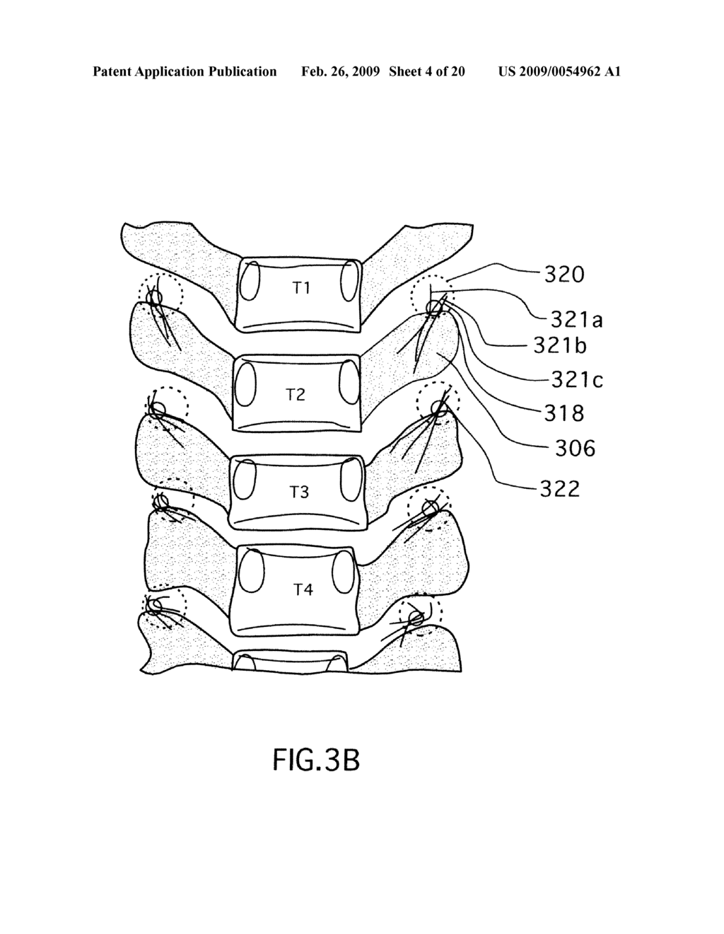 METHODS FOR TREATING THE THORACIC REGION OF A PATIENT'S BODY - diagram, schematic, and image 05