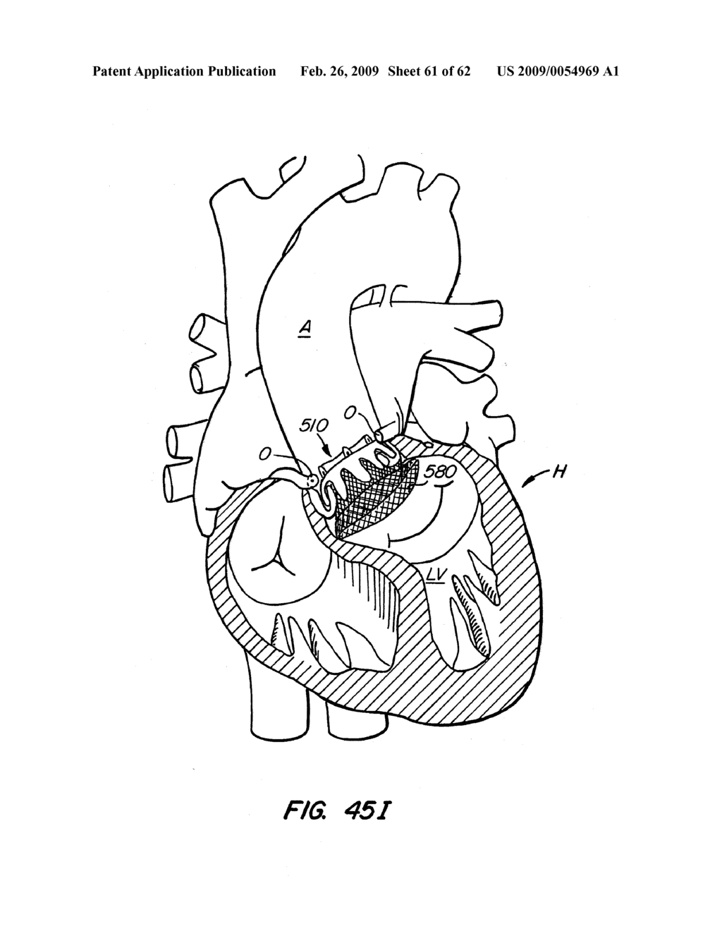 Repositionable Heart Valve and Method - diagram, schematic, and image 62