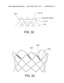 ATRAUMATIC STENT WITH REDUCED DEPLOYMENT FORCE, METHOD FOR MAKING THE SAME AND METHOD AND APPARATUS FOR DEPLOYING AND POSITIONING THE STENT diagram and image