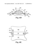 MULTI-LUMEN MOLD FOR INTERVERTEBRAL PROSTHESIS AND METHOD OF USING SAME diagram and image