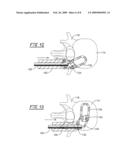 TRANSFORAMINAL LUMBAR INTERBODY FUSION CAGE diagram and image