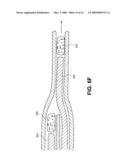 METHODS AND DEVICES FOR OCCLUDING AN OVARIAN PATHWAY diagram and image