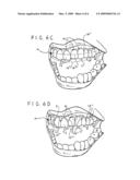 Therapeutic and protective dental device useful as an intra-oral delivery system diagram and image