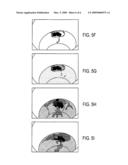 CONTAINMENT SYSTEM FOR DELIVERY OF BIOLOGICAL PRODUCTS AND METHOD OF SURGERY diagram and image