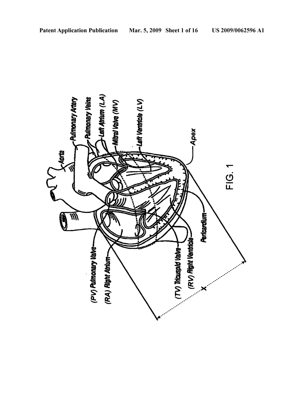 Heart band with fillable chambers to modify heart valve function - diagram, schematic, and image 02