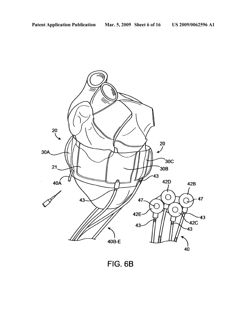 Heart band with fillable chambers to modify heart valve function - diagram, schematic, and image 07