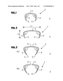 Clip-Like Implant for Osteosynthesis diagram and image